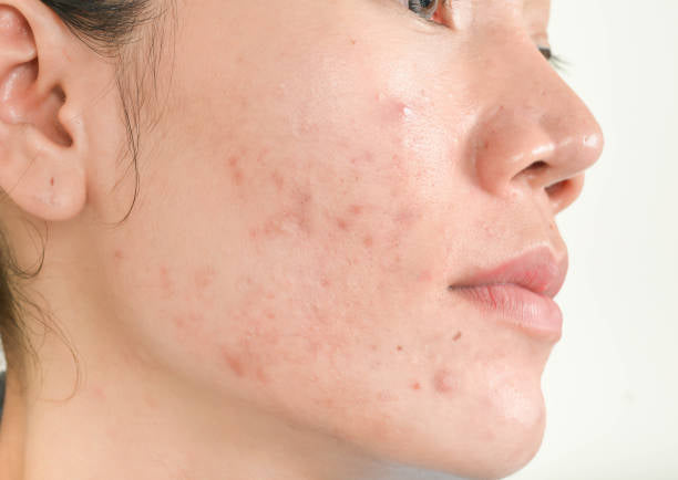 Calm + Clear Breakout Serum