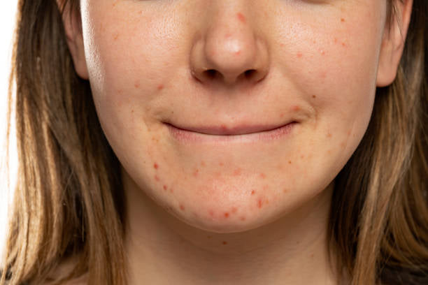 Calm + Clear Breakout Serum
