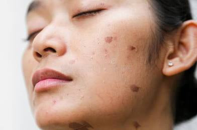 Renewal Healing Scar Oil