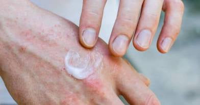 Calming Eczema Relief Body Oil