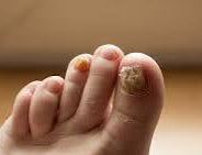 Forest Remedy Foot Scrub Bar - anti fungal scrub bar
