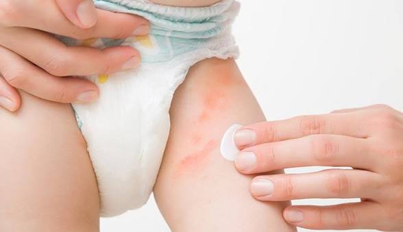 Golden Cradle Guard – Botanical Antifungal Baby Salve