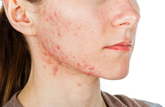 Face Clear Calm Mist - Hydrating, Calming, Made for Breakouts