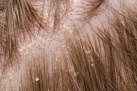 Flake & Fern Herbal Scalp Dandruff Tonic