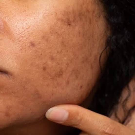 Radiant Renewal Face Oil - For Hyperpigmentation & Uneven Skintone