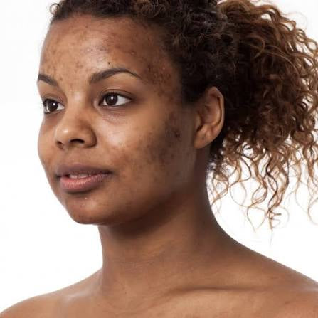 Radiant Renewal Face Oil - For Hyperpigmentation & Uneven Skintone